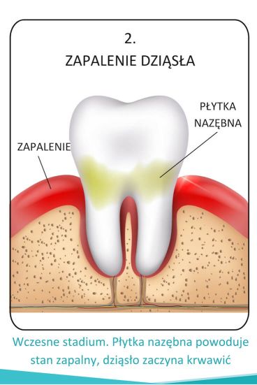 Etapy rozwoju paradontozy zapalenie dziąseł grafika