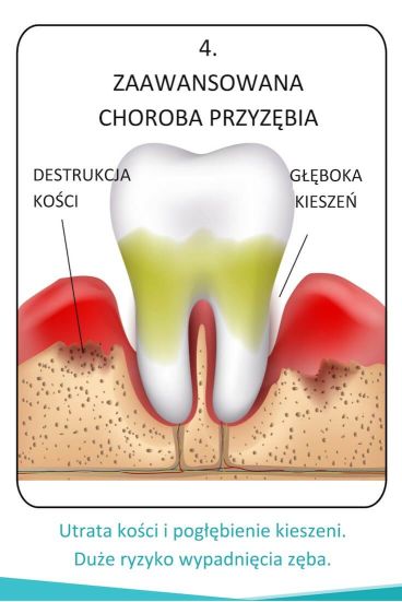 Etapy paradontozy zaawansowane stadium grafika