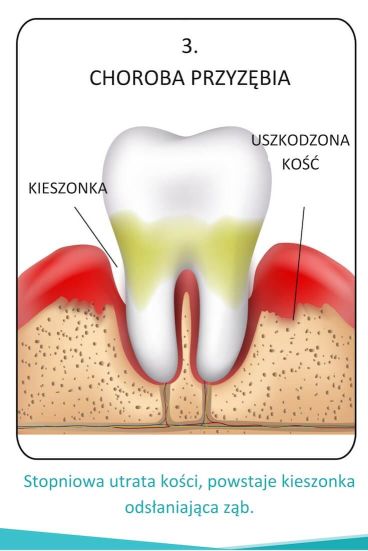 Etapy paradontozy choroba przyzębia grafika