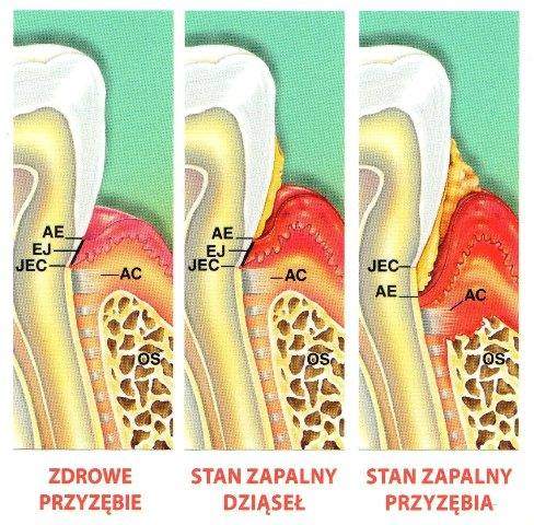 eatpy rozwoju chorób przyzębia