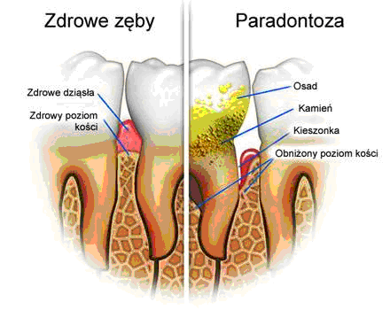 Zapalenie dziąseł i paradontoza