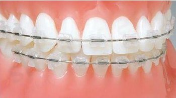 Ligatury Uno - Gumki ortodontyczne 26 szt. - przezroczyste