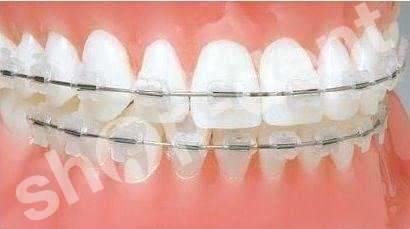 Ligatury Uno - Gumki ortodontyczne 26 szt. - przezroczyste
